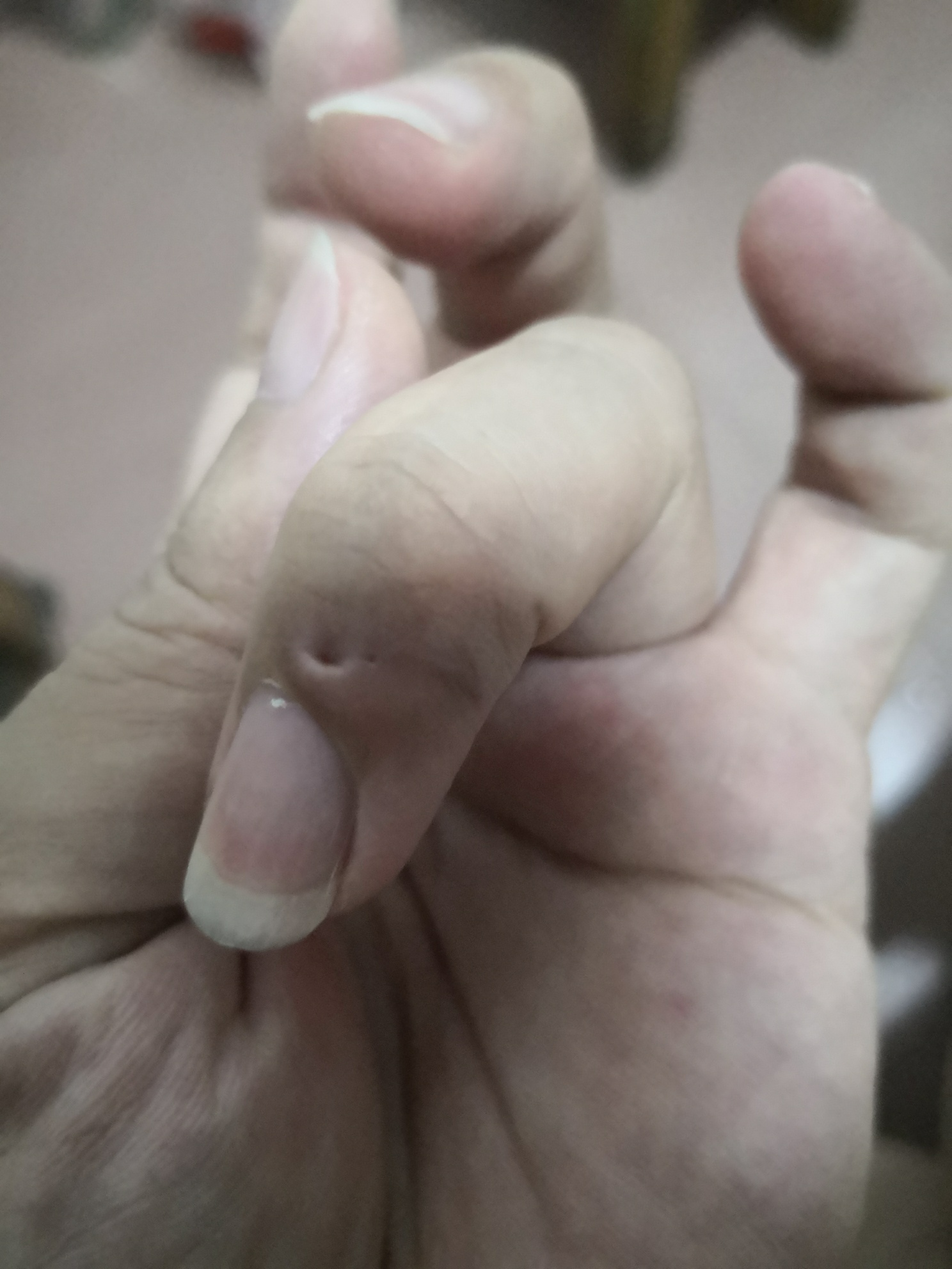 每个人或多或少都有疤痕，你身上的疤痕有什么故事呢？964 / 作者:猛龙 / 帖子ID:285784