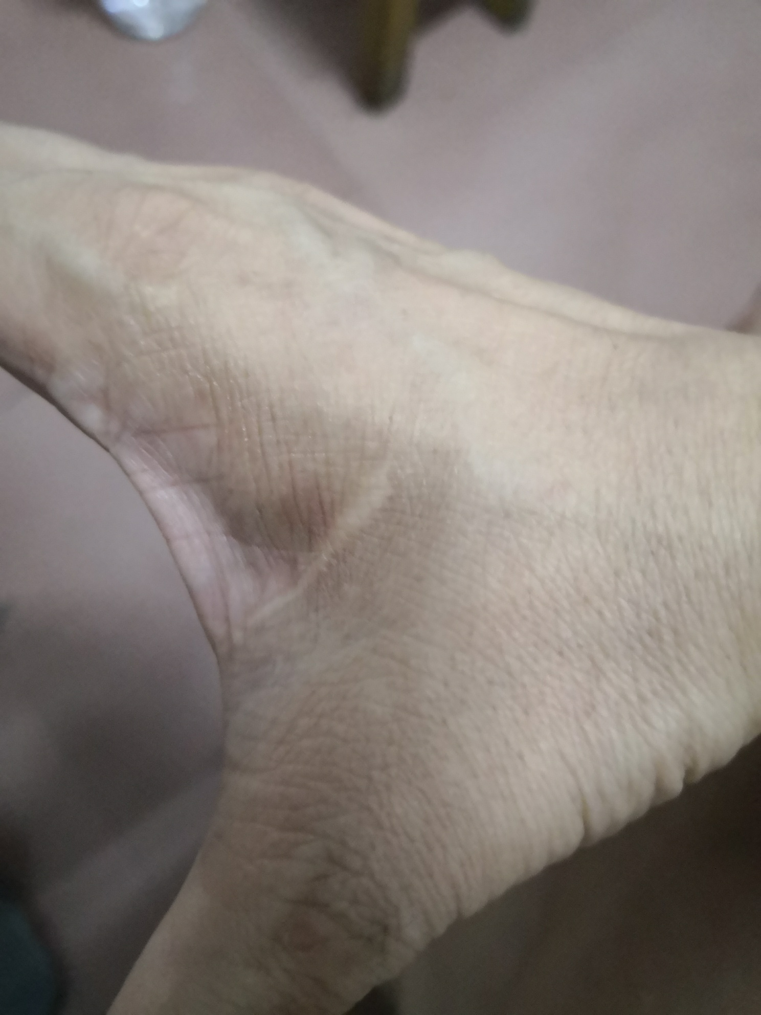 每个人或多或少都有疤痕，你身上的疤痕有什么故事呢？833 / 作者:猛龙 / 帖子ID:285784
