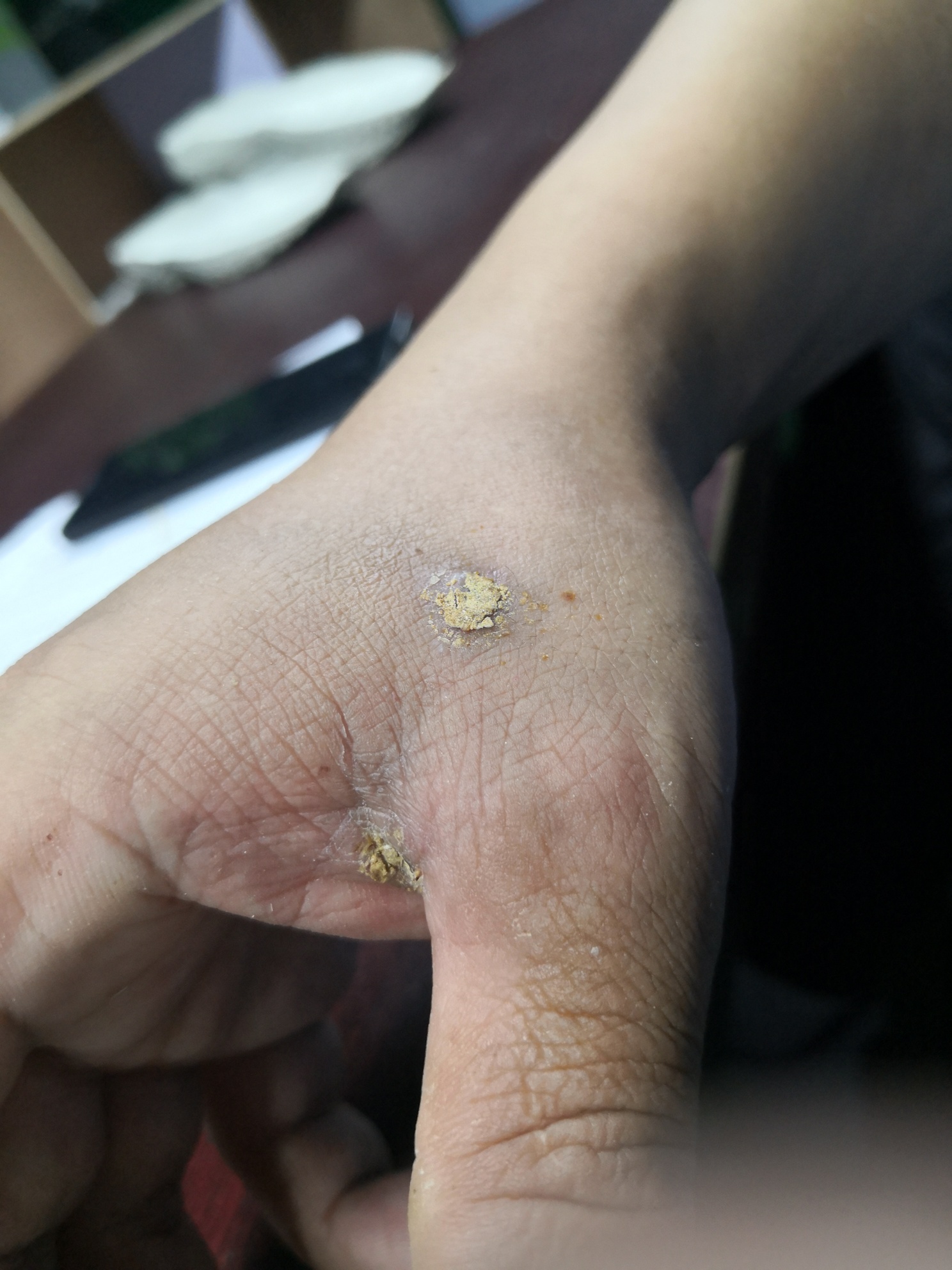 一镖过去花了五六千，今天上班了884 / 作者:猛龙 / 帖子ID:306678